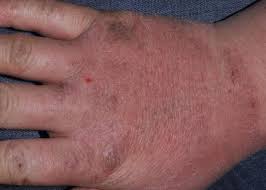 Image result for dermatitis contacta