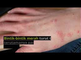 Penyakit gatal kurap atau ringworm merupakan penyakit infeksi pada kulit bagian, tidak seperti namanya ringworm bukanlah penyakit yang diakibtkan oleh cacing tetapi diakibtkan oleh jamur kulit yang termasuk golongan dermatofita atau dermatofitosis. Kudis Scabies Penyebab Dan Rawatan Penyakit Kudis Doctoroncall