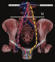 • will you know for sure whether i have cancer? Drawing Shows Common Routes Of Nodal Metastasis From Testicular Cancer Download Scientific Diagram