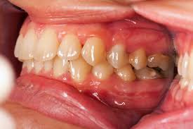 Image result for Infections in the mouth
