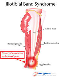 Iliotibial Band Syndrome Wikipedia