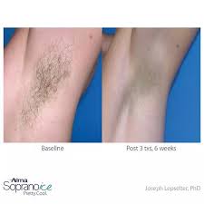 Trusted ipl therapy specialist serving st. Laser Hair Removal Near Me Cheap