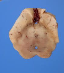 Image result for Pallidotomy