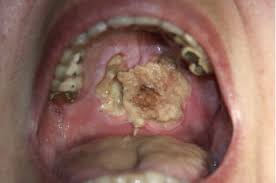 Check spelling or type a new query. The Clinical Histologic And Treatment Spectrum In Necrotizing Sialometaplasia Oral Surgery Oral Medicine Oral Pathology And Oral Radiology