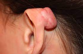 Dermatology Archives Florida Keloid Center