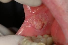 Image result for spinocellular carcinoma of the oral cavity
