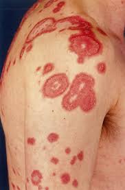 Lupus shares a lot of symptoms with other diseases, like arthritis and diabetes. Systemic Lupus Erythematosus Amboss
