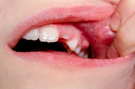 Image result for Periodontal Abscess