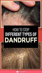Different Types Of Dandruff And How To Stop Them Natural Dandruff Remedy Hair Dandruff Hair Mask For Dandruff