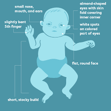 down syndrome signs symptoms and characteristics