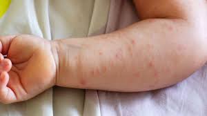 Image result for dermatitis contacta children