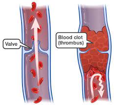 Etiologia existen varios factores de riesgo bien reconocidos que actúan para Trombosis Venosa Superficial Centro Vascular Y Endovascular