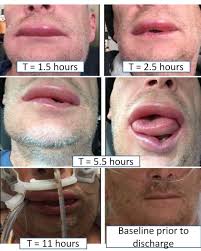 Image result for Angioedema