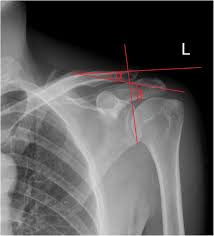 Boning up on humerus, clavicle, and ac joint positioning. Relationship Between The Lateral Acromion Angle And Postoperative Persistent Pain Of Distal Clavicle Fracture Treated With Clavicle Hook Plate Journal Of Orthopaedic Surgery And Research Full Text