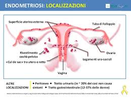 Posso essere presenti alcuni o tutti i seguenti sintomi l'endometriosi è una patologia che può avere notevoli implicazioni psicologiche per la paziente in quanto Che Cos E L Endometriosi Studio Medulla