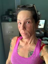 Dealing with painful swollen lumps in neck and shoulder areas