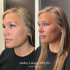 Effortlessly enhanced, naturally balanced 🤍✨ This beauty came in with a  youthful facial structure and minimal fat pad volume loss. Despite her  natural fullness, we added subtle contouring and precise volumization to