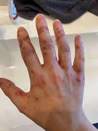 Hand Mund Fuss Bei Erwachsenen Ansteckend Und Schmerzhaft