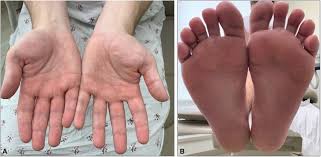Image result for dyshidrosis