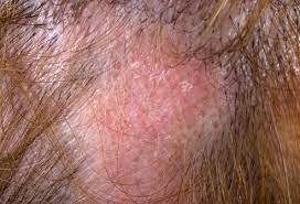 Atopic dermatitis is a type of eczema that causes a red rash and itchiness. Tips To Help With Loss Of Hair Now Coinpet7numbers
