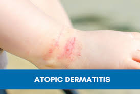 Image result for Atopic eczema atopic dermatitis