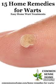 15 home remes for warts easy home
