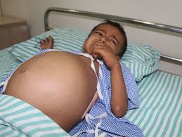 Your stomach receives and holds the food you eat and then helps to break down and digest it. Baby S Stomach Has Swollen To The Size Of A Football Because Of Cancer Milaap