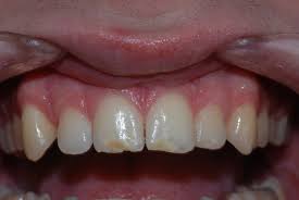 Kinderbehandlung Die Behandlung Von Kindern Mit Mih Zahnen Molar Incisor Hypomineralisation