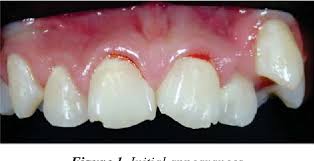 Image result for Tooth Luxation