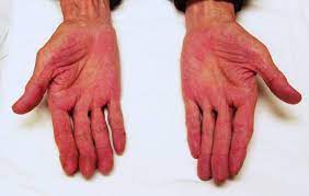 Here, it is the increased estrogen levels in the blood that is thought to trigger the condition. Image Cirrhosis Palmar Erythema Msd Manual Professional Edition