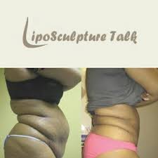 Pin On Laser Lipo Before And After