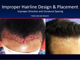 I got a septorhinoplasty, and i still look like a deflated baby with a receding hairline. The Ugly Side Of The Hair Transplant Industry