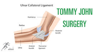 This ligament can tear after repeated overuse, typically from an overhead pitching motion, causing the elbow to be unstable. Tommy John Surgery For A Ucl Injury Of The Elbow Youtube