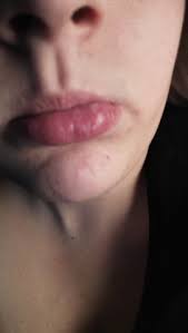 Offene wunden oder blutende stellen sind ebenfalls typisch für. Lippe Geschwollen Und Komische Blase Gesundheit