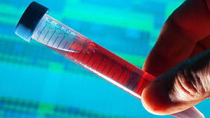 The test is based on dna that is shed by tumours and found circulating in the blood. Liquid Biopsy Works For Early Detection Of Lung Cancer Everyday Health