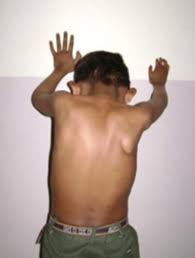 This syndrome effects 1 in 20,000 newborns, however it is twice as common in ctm people than ctf people. Https Ispub Com Ijos 12 1 5058
