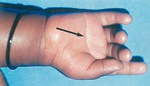 In fact, clinical examination in the newborn period may be entirely normal. Congenital Disorders Photographs