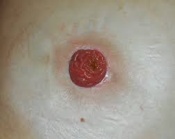 Enterostoma Wikipedia
