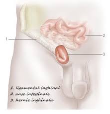 Interventia chirurgicala deschisa se efectueaza cu pacientul sub anestezie locala sau generala. West Clinique BrÄila Hernia Inghinala AdÄugat La 15 Iulie 2010 De Dr Gabriel Matei In Categoria Chirurgie LaparoscopicÄ Hernii Abdominale 9 Comentarii Ce Este Hernia Inghinala Hernia Inghinala Are Ca