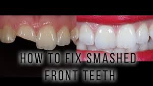 Depending on how much of the tooth is broken, you might need a crown, a veneer or a simple filling. How To Fix Smashed Front Teeth Youtube