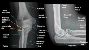 Image result for Coronoid Process Fracture