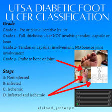 Image result for IDSA Diabetic Foot Wound Classification