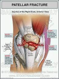 Upon flexion of the knee, however, a shortened lateral retinaculum will come under excessive stress as the patella is drawn in the trochlea and the iliotibial band pulls posteriorly on the already shortened lateral retinaculum. Patellar Fracture Of The Right Knee With Torn Retinaculum Medical Malpractice Cases Medical Illustration Medical