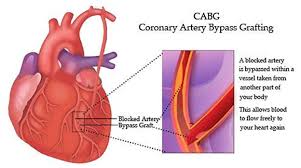 Coronary Artery Bypass Graft