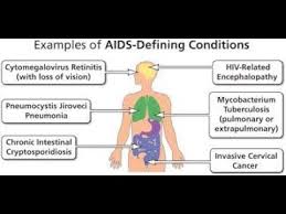 Image result for AIDS-Defining Illness