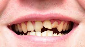 And more people in the us were. British People Are Becoming Internationally Renowned For Having Bad Teeth Here S How To Keep Yours Healthy And White Huffpost Uk Life