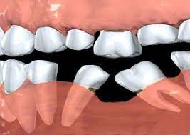 Pin En Dental Implants