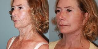 Larry S. Nichter, MD, MS, FACS, Board Certified Plastic Surgeon