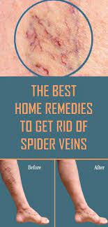 The Best Home Remedies To Get Rid Of Spider Veins Get Rid Of Spider Veins Foods For Brain Health Spider Veins