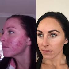 Beauty Treatments I'm Loving Right Now for Glowing Skin